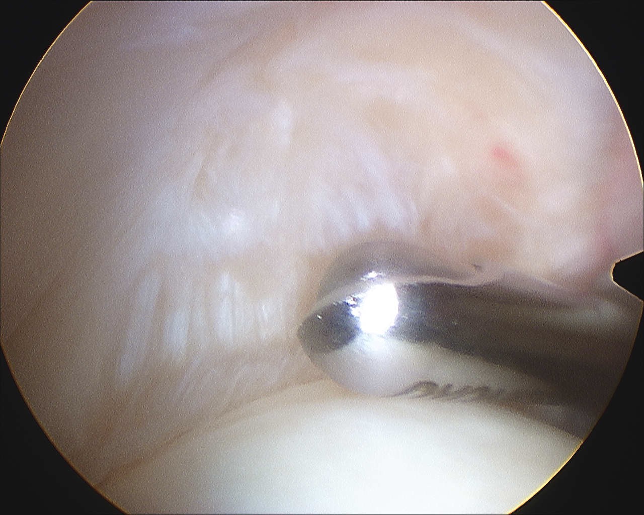 Shoulder Scope PASTA Debridement